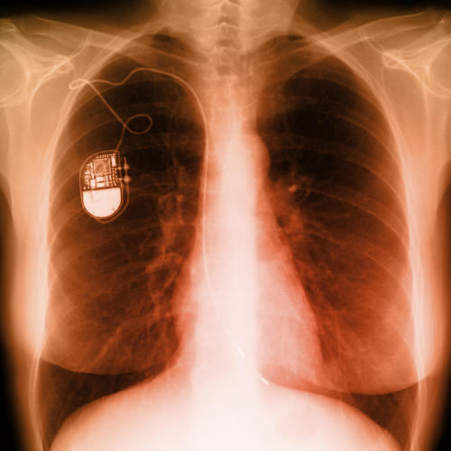 In the future, pacemakers coated with the material might be rechargeable without needing to remove them from the body.